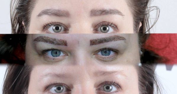 Micro Brow Implant Nedir? 